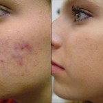 Consejos para eliminar el acne