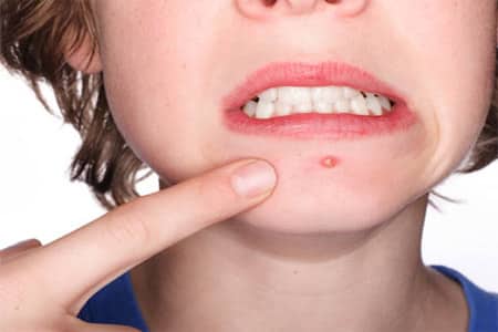 Trucos para combatir el molesto acne